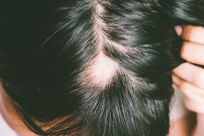 Understanding Alopecia Areata
