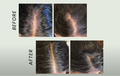 5 Things I Did Wrong When I Was Trying to Regrow My Hair