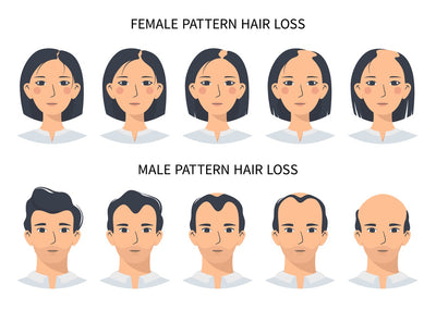 Understanding Male and Female Pattern Baldness