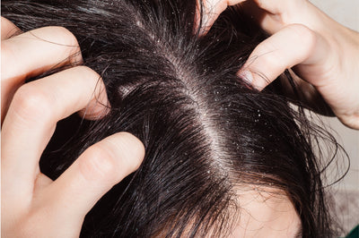 Dry Scalp vs. Dandruff