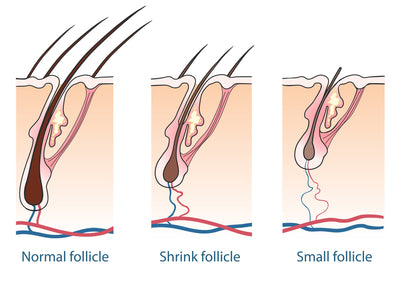 5 most common types of hair loss