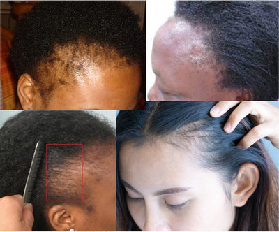 Everything you need to know about Traction Alopecia